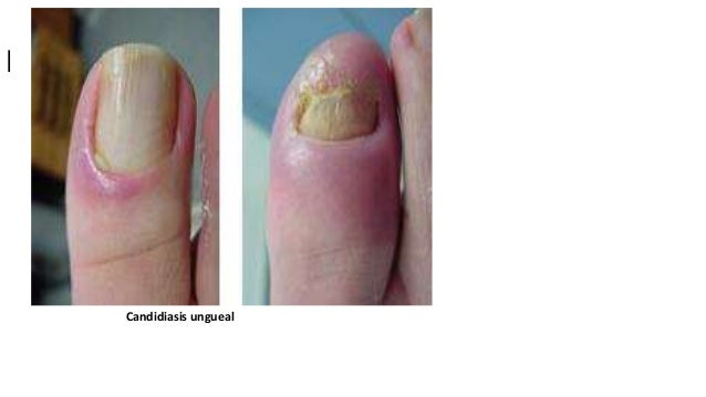 La enfermedad de las uñas en los pies por el hongo