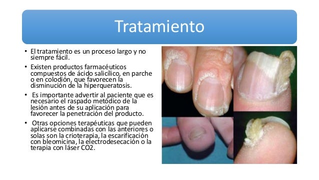 Los medios públicos del tratamiento de las uñas en las manos del hongo