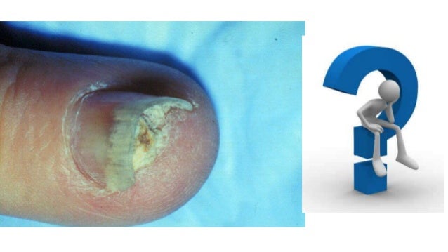 El tratamiento de la psoriasis en la vena