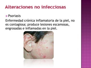  Psoriasis
Enfermedad crónica inflamatoria de la piel, no
es contagiosa; produce lesiones escamosas,
engrosadas e inflamadas en la piel.
 