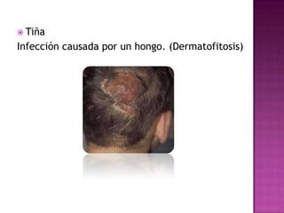  Tiña
Infección causada por un hongo. (Dermatofitosis)
 