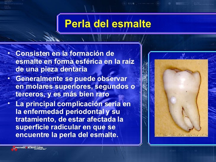 Alteracioneshereditariasdeladentina