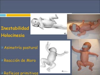 Inestabilidad
Holocinesia

   Asimetría postural


   Reacción de Moro


   Reflejos primitivos
 
