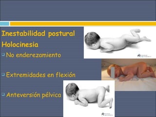 Inestabilidad postural
Holocinesia
   No enderezamiento


   Extremidades en flexión


   Anteversión pélvica
 