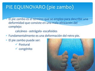 PIE EQUINOVARO (pie zambo)

 El pie zambo es el término que se emplea para describir una
 deformidad que consiste en una mala alineación del
 complejo:
       calcáneo - astrágalo- escafoides
 Fundamentalmente es una deformación del retro pie.
 El pie zambo puede ser:
        Postural
        congénito
 