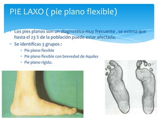 PIE LAXO ( pie plano flexible)

 Los pies planos son un diagnostico muy frecuente . se estima que
 hasta el 23 % de la población puede estar afectada.
 Se identificas 3 grupos :
     Pie plano flexible
     Pie plano flexible con brevedad de Aquiles
     Pie plano rígido.
 