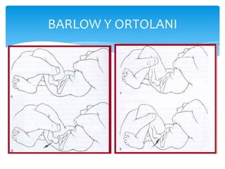 BARLOW Y ORTOLANI
 