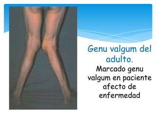 Genu valgum del
    adulto.
  Marcado genu
valgum en paciente
     afecto de
   enfermedad
 