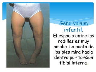 Genu varum
    infantil.
El espacio entre las
   rodillas es muy
amplio. La punta de
los pies mira hacia
dentro por torsión
    tibial interna.
 