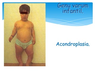 Genu varum
 infantil.




Acondroplasia.
 