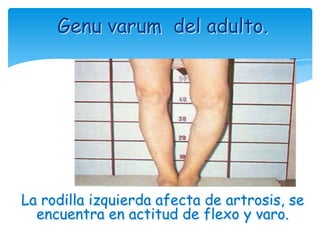 Genu varum del adulto.




La rodilla izquierda afecta de artrosis, se
  encuentra en actitud de flexo y varo.
 