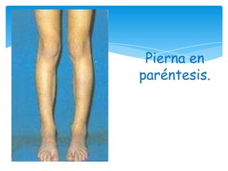 Pierna en
paréntesis.
 