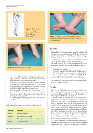 tintas partes del aparato locomotor para descartar pato-
logías asociadas a deformidades del pie, evitando así
posteriores dificultades en su tratamiento.
Ante una deformidad del pie es fundamental explorar
su flexibilidad y valorar el grado de rigidez de las distin-
tas articulaciones, pues cuanto más rígida y estructurada
esté la deformidad más difícil será de corregir.
Las deformidades del pie pueden afectar a una o a va-
rias articulaciones del mismo, así como a los tejidos
blandos circundantes. Aunque pueden ser adquiridas, la
mayor parte son congénitas.
Se describen: pie equino, valgo, varo, cavo, plano, adducto
y zambo7:
Pie equino
Deformidad del pie caracterizada porque la totalidad del
mismo está sostenida en posición de flexión plantar con
relación a la pierna. La contractura del músculo tríceps
(tendón de Aquiles acortado) es la causa de que el pie
adopte esta posición. El individuo realizará la marcha
con el apoyo del antepié (marcha de puntillas) (fig. 8).
No suele constituir una entidad patológica aislada. Suele
encontrarse asociado a otro tipo de deformidades del pie:
– Pie equino varo (zambo).
– Pie equino valgo (parálisis del músculo tibial posterior).
– Pie equino de los trastornos neuromusculares. Espe-
cialmente de la parálisis cerebral infantil (PCI). Es la
deformidad más frecuente en estos paciente (fig. 3).
Su valoración y tratamiento deben realizarse en un ser-
vicio de ortopedia infantil.
Pie valgo
Este tipo de deformidad se define como el pie cuyo ta-
lón está en eversión y su parte distal se encuentra en
eversión y abducción (fig. 9). El arco de dorsiflexión y
flexión plantar del tobillo es normal.
Existe una forma en la que el pie está en eversión com-
pleta (valgo), con flexión dorsal máxima, lo que consti-
tuye el pie talo valgo (fig. 3). Los tejidos blandos del
dorso y la porción lateral del pie muestran contracción
(contractura de musculatura peronea) y limitan la fle-
xión plantar y la inversión. Radiográficamente, son pies
de estructura ósea normal. No hay luxación o subluxa-
ción de los huesos del tarso. Este tipo de deformidad es
la más frecuente en partos de presentación podálica
(madres jóvenes y primíparas). La causa es debida a:
posición defectuosa del feto, compresión por útero pe-
queño o musculatura abdominal potente8,9.
En los pies flexibles se inicia el tratamiento con manipu-
laciones, y en la mayoría de los casos la musculatura va
adquiriendo tono y el pie se va equilibrando espontánea-
254 An Pediatr Contin. 2006;4(4):251-8
VENTANA A OTRAS ESPECIALIDADES
Deformidades del pie
J. Muñoz
Figura 8. Esquema de un
enfermo hemiplégico con
apoyo del pie derecho en
equino por atrofia del
tríceps sural.
Figura 8. Esquema de un
enfermo hemiplégico con
apoyo del pie derecho en
equino por atrofia del
tríceps sural.
Figura 9. Imágenes de pies talo-valgos.
Figura 10. Imagen de pie derecho astrágalo vertical
congénito. Se aprecia el retropié en equino y el antepié
en flexión dorsal.
Localización Deformidad
Retropié Equino-varo-valgo
Mediopié Cavo (equino del antepié)
Plano (aplanamiento de la bóveda plantar)
Antepié Adductus-abductus
Tabla 2. Localización anatómica de las deformidades del pie
10_Ventana.qxd 3/7/06 09:13 Página 254
Documento descargado de http://www.apcontinuada.com el 21/04/2014. Copia para uso personal, se prohíbe la transmisión de este documento por cualquier medio o formato.
 
