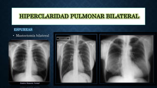HIPERCLARIDAD PULMONAR BILATERAL
ESPUREAS
• Mastectomía bilateral
 