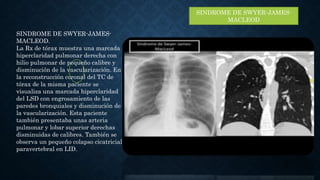 SINDROME DE SWYER-JAMES-
MACLEOD
SINDROME DE SWYER-JAMES-
MACLEOD.
La Rx de tórax muestra una marcada
hiperclaridad pulmon...