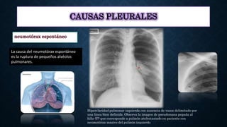CAUSAS PLEURALES
neumotórax espontáneo
La causa del neumotórax espontáneo
es la ruptura de pequeños alvéolos
pulmonares.
H...