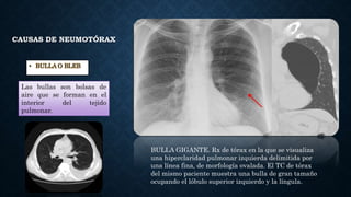 CAUSAS DE NEUMOTÓRAX
• BULLA O BLEB
Las bullas son bolsas de
aire que se forman en el
interior del tejido
pulmonar.
BULLA ...