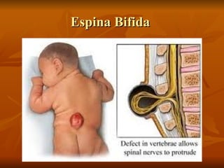 Espina Bifida
Espina Bifida
 