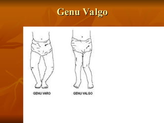 Genu Valgo
Genu Valgo
 