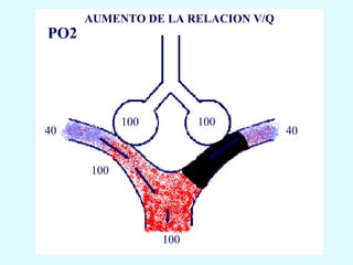 AUMENTO DE LA RELACION V/Q
PO2




            100         100
40                                 40


      100




                  100
 