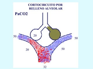 CORTOCIRCUITO POR
        RELLENO ALVEOLAR
PaCO2




50        20
                             50


     20                 50




               32
 