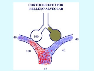 CORTOCIRCUITO POR
      RELLENO ALVEOLAR




40         100
                           40


     100              40




                 47
 