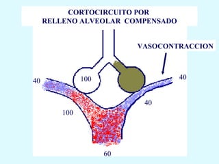 CORTOCIRCUITO POR
     RELLENO ALVEOLAR COMPENSADO


                          VASOCONTRACCION



               100                 40
40


                           40
         100




                     60
 