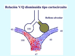 Relación V/Q disminuida tipo cortocircuito


                           Relleno alveolar



   40           100
                                        40


          100                 40




                      47
 