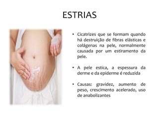 ESTRIAS
• Cicatrizes que se formam quando
há destruição de fibras elásticas e
colágenas na pele, normalmente
causada por um estiramento da
pele.
• A pele estica, a espessura da
derme e da epiderme é reduzida
• Causas: gravidez, aumento de
peso, crescimento acelerado, uso
de anabolizantes
 