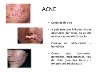 ACNE
• Condição da pele
• A pele tem seus folículos pilosos
obstruídos por sebo, ou células
mortas, causando inflamação
• Comum na adolescência –
hormônios
• Causas e/ou agravantes:
hormônios, medicamentos, tipo
de dieta (produtos lácteos e
excesso de carboidratos)
 