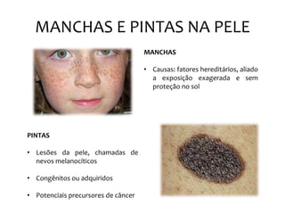 MANCHAS E PINTAS NA PELE
MANCHAS
• Causas: fatores hereditários, aliado
a exposição exagerada e sem
proteção no sol
PINTAS
• Lesões da pele, chamadas de
nevos melanocíticos
• Congênitos ou adquiridos
• Potenciais precursores de câncer
 