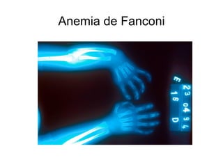 Anemia de Fanconi
 