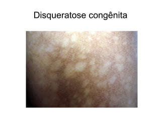 Disqueratose congênita
 