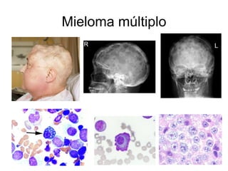 Mieloma múltiplo
 
