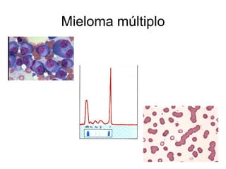 Mieloma múltiplo
 