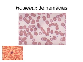Rouleaux de hemácias
 