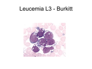 Leucemia L3 - Burkitt
 