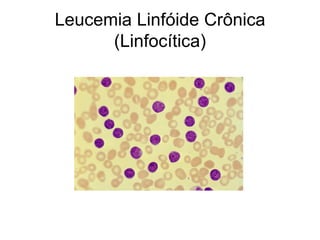 Leucemia Linfóide Crônica
      (Linfocítica)
 