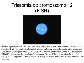 Trissomia do cromossomo 12
                      (FISH)




FISH analysis revealed trisomy 12 in 80% of the interphase cells (yellow). Trisomy 12 is
associated with atypical morphologic features including cleaved nuclei and/or increased
numbers of prolymphocytes, bright CD20 expression, absence of CD23 and expression
of FMC-7. In contrast to mantle cell lymphoma, "atypical" CLL is negative for t(11;14)
and cyclin D1 expression. Patients with Trisomy 12 are stratified into an intermediate risk
category.
 