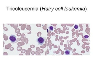Tricoleucemia (Hairy cell leukemia)
 