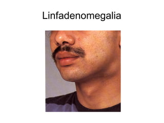 Linfadenomegalia
 