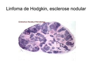 Linfoma de Hodgkin, esclerose nodular
 