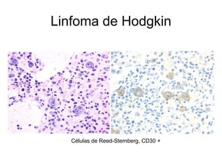 Linfoma de Hodgkin




   Células de Reed-Sternberg, CD30 +
 