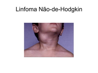 Linfoma Não-de-Hodgkin
 