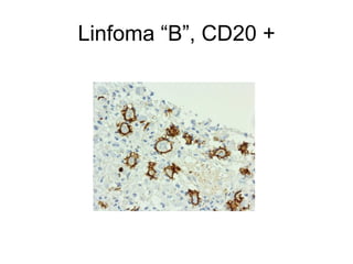 Linfoma “B”, CD20 +
 