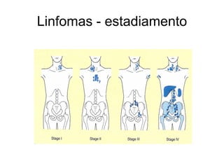 Linfomas - estadiamento
 