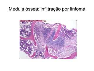 Medula óssea: infiltração por linfoma
 