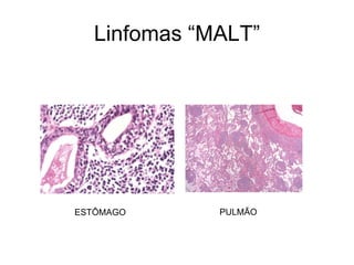 Linfomas “MALT”




ESTÔMAGO      PULMÃO
 