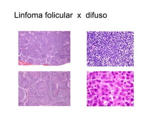 Linfoma folicular x difuso
 