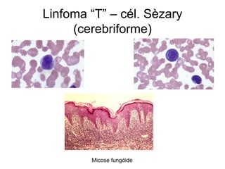 Linfoma “T” – cél. Sèzary
     (cerebriforme)




        Micose fungóide
 